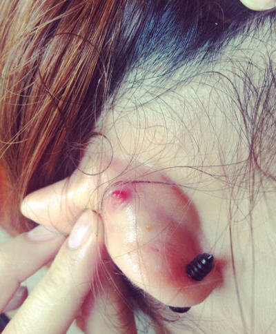 打完耳洞发炎怎么办-打了耳洞发炎快速处理方法1