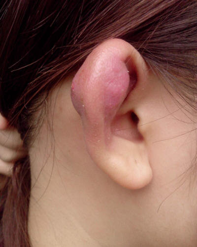 打完耳洞发炎怎么办-打了耳洞发炎快速处理方法2