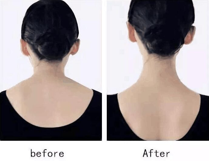 瘦肩针有什么危害-打了瘦肩针会反弹吗1