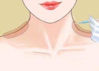 瘦肩针有什么危害-打了瘦肩针会反弹吗2