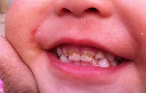别让孩子吃大人的口水-防止宝宝长蛀牙(龋齿)1