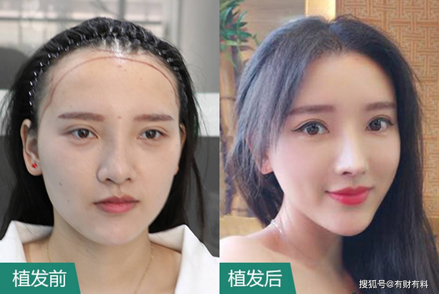 原创 2.5亿“脱发青年”催生百亿市场!事出“秃”然,还是另有原因?5